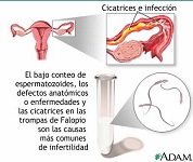 Infertilidad